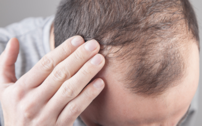 Nouvelles Révélations sur les Variants Génétiques Rares de la Chute de Cheveux