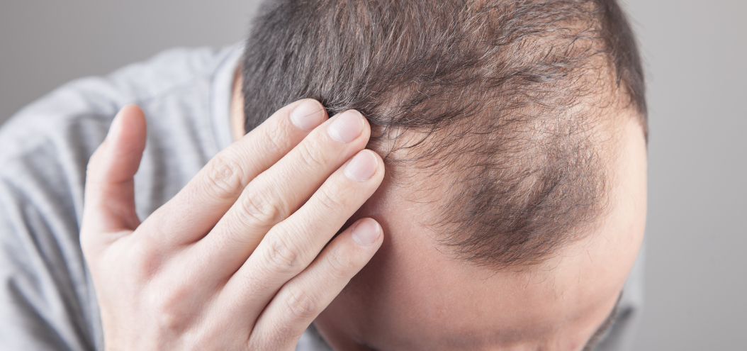 homme-qui-perd-ses-cheveux homme-qui-perd-ses-cheveux