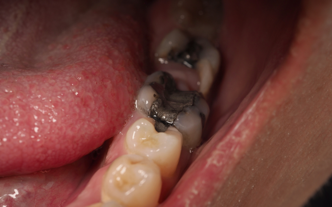 Révolution en Hygiène Buccale : Un Bain de Bouche Innovant pour la Détection des Caries