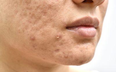 Solutions pour le traitement des cicatrices d’acné