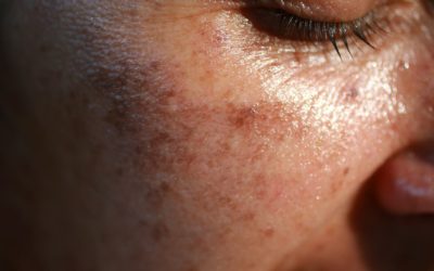Combattre les taches pigmentaires : comment transformer votre peau ?