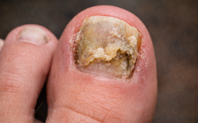 Mycose des ongles : comprendre cette infection, la traiter correctement et éviter les récidives